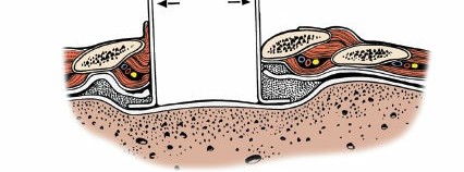 Illustration 319 for Approach to the Lumbar Spine: Mastering Techniques & Anatomy