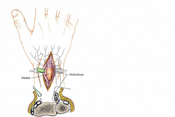 Illustration 17 for Dorsal Wrist Approach: Expert Access to the Column of the Distal Radius