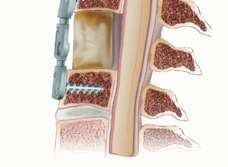 Illustration 26 for How ACDF Clears Your Posterior Disc Space for Lasting Relief