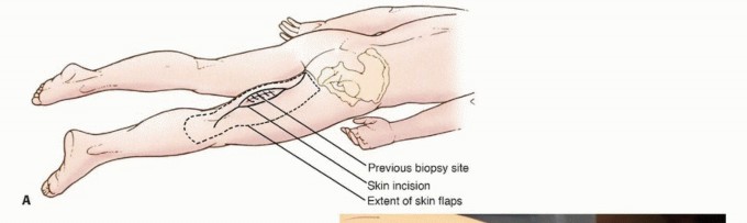 Illustration 8 for Posterior Thigh Resection: Rethinking Outcomes & Limb Sparing