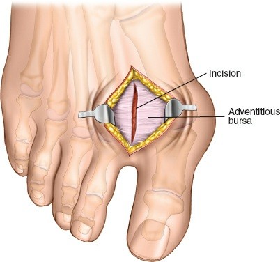 Illustration 207 for Optimized Approaches to the Dorsum of the Foot & Ankle