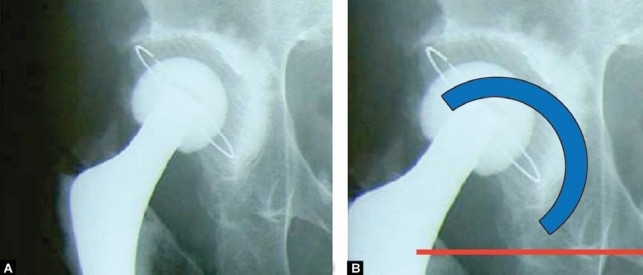 Illustration 8 for Optimizing Acetabular Component Cementation for Superior Outcomes