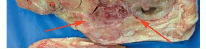Illustration 8 for Treating Tumors of the Foot: Optimizing Amputation & Resection