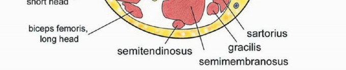 Illustration 4 for Limb-Sparing Quadriceps Resection: Superficial Femoral Artery