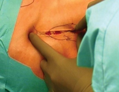 Illustration 3 for Mastering the Anterolateral Approach in Minimally Invasive Hip Replacement