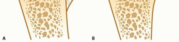 Illustration 3 for Latarjet for Instability: Bone Loss Solutions, Per Burkhart SS, Lo