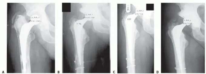 وحدة إكستر للورك: إتقان تطعيم العظام بالضغط لمعالجة فقدان عظم الفخذ في صنعاء مع الأستاذ الدكتور محمد هطيف