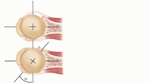 Illustration 28 for Finally Treat Recurrent Posterior Instability of the Shoulder