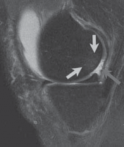 Illustration 3 for Microfracture Chondroplasty: How Tiny Holes Are Made to Fix Cartilage
