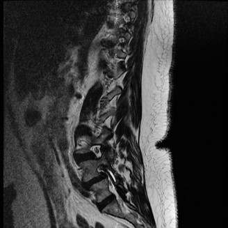 Illustration 6 for Spondylodiscitis: Deciphering the next course of action