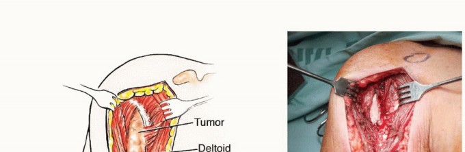 Illustration 8 for Restore Vital Function: Surgery for Type II Humeral Metastasis