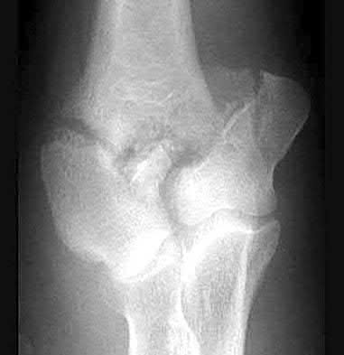 Illustration 85 for OrthoCash: Trauma MCQs & Cases for a yearold woman