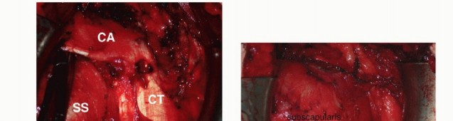 Illustration 13 for Glenoid Bone Graft for Anterior Shoulder Instability: Restore Stability