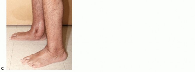 Illustration 31 for Beyond Amputation: Circular Fixation for Infection of the Talus