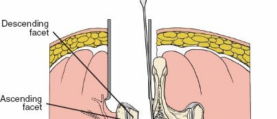 Illustration 23 for Mastering the Spine Posterior Approach: Surgical Essentials