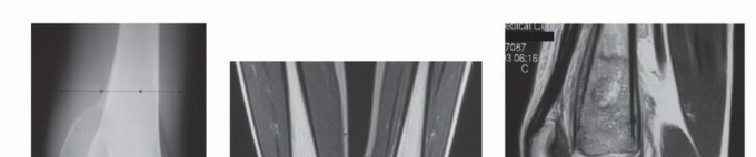 Illustration 16 for Precision Biopsy of Musculoskeletal Tumors for Accurate Diagnosis