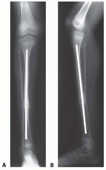 Illustration 11 for Williams Rod: Achieve Stability for Pseudarthrosis within the Tibia