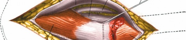 Illustration 112 for Unlocking Every Aspect of the Hip's Surgical Approaches