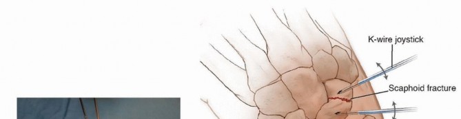 Illustration 5 for Mastering Percutaneous Fixation of Acute Scaphoid Fractures