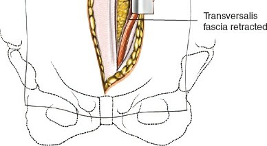 Illustration 89 for Approach to the Lumbar Spine: Mastering Techniques & Anatomy
