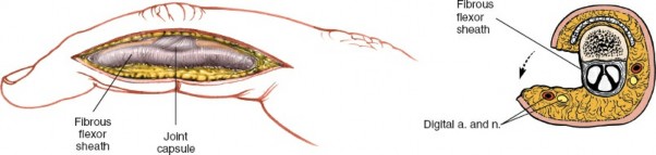 Illustration of flexor sheaths proximal - Dr. Mohammed Hutaif