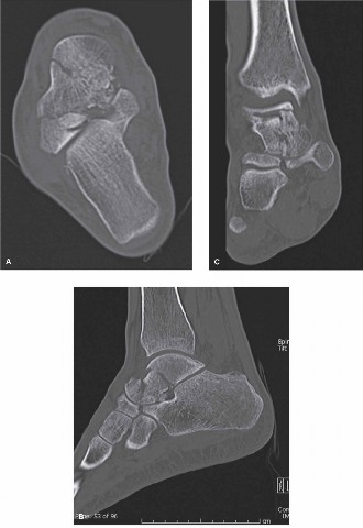Illustration 2 for Displaced Talar Neck Fracture: Optimal Treatment Revealed