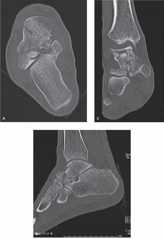 كسر عنق الكاحل المزاح: دليلك الشامل للعلاج والتعافي مع الأستاذ الدكتور محمد هطيف