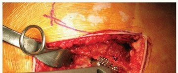 Illustration 20 for Why Polished Tapered Cemented Stems Excel in Hip Replacement