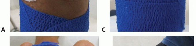 Illustration 46 for Plantar Plate Repair: End Lesser Toe Pain & Instability