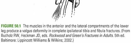 Pediatric Tibia and Fibula Fractures: Essential Clinical Insights