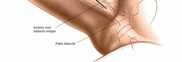 Illustration 211 for Unlocking Every Aspect of the Hip's Surgical Approaches