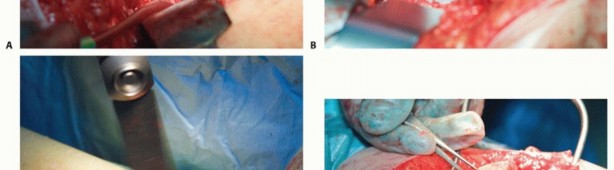 Illustration 23 for Special THA Techniques for Severe Deformities Around the Hip
