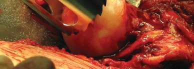 Illustration 37 for Figure Hip Resurfacing: Who Benefits and Who Should Avoid It?