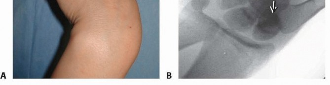 Illustration 2 for Mastering Percutaneous Fixation of Acute Scaphoid Fractures