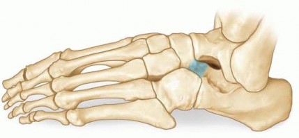 Resection of Calcaneonavicular: Solving Rigid Flatfoot Pain