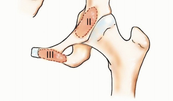 Illustration 2 for Pelvic Metastasis Surgery: A Component of the Utilitarian Approach