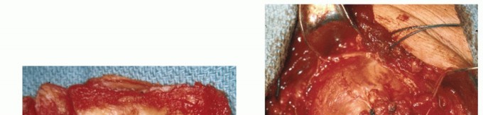 Illustration 19 for Subscapularis & Teres Rotator Cuff Repair: Advanced Techniques