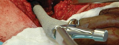 Illustration 108 for Femoral Stem Revision: Posterior Approach for Better Outcomes