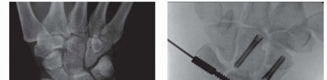 Illustration 18 for Arthroscopic Fixation: Effectively Treating Radial Styloid Fragments