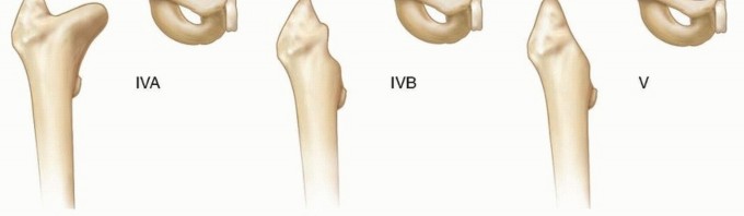 Illustration 25 for Septic Hip in Children: Mastering Anterior Drainage for Optimal Recovery