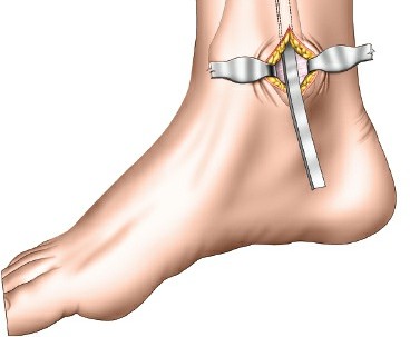 Illustration 69 for Surgical Access: Mastering the Tibia's Surface & Fibula Approaches