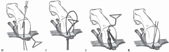 Illustration 25 for Plantar Plate Repair: End Lesser Toe Pain & Instability