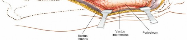Illustration 34 for Optimal Femoral Approaches: Mastering the Lateral Intermuscular Septum