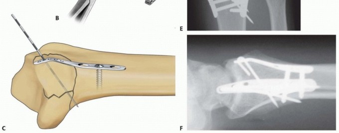 Illustration 39 for Fragment-Specific Fixation: Restore Carpal Facet Horizon