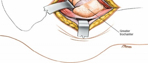 Illustration 141 for Unlocking Every Aspect of the Hip's Surgical Approaches