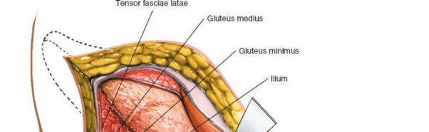 Illustration 53 for Unlocking Every Aspect of the Hip's Surgical Approaches