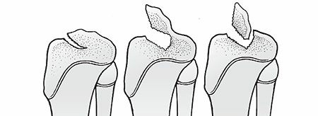 Illustration 31 for Master Pediatric Femoral Shaft & Knee Fractures: Interactive Module