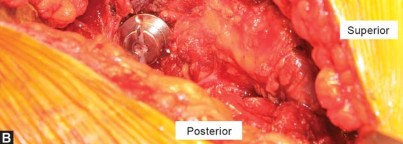 Illustration 16 for Robotics in Total Hip Arthroplasty: A New Era of Precision
