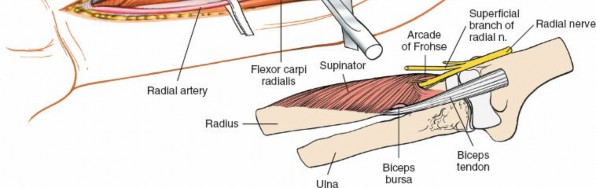 Illustration 13 for Radius Anterior Approach: Safe Nerve Protection & Complete Exposure