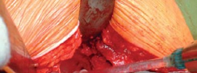 Illustration 14 for Optimizing Acetabular Component Cementation for Superior Outcomes